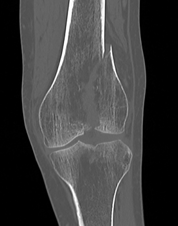 Unicondylar CT